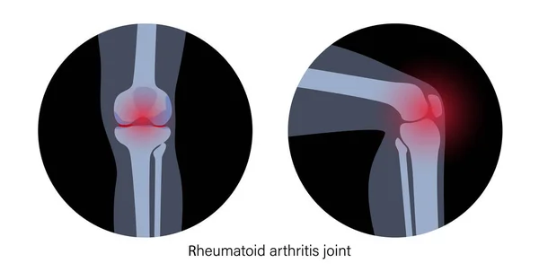 Artritis en la articulación de rodilla — Vector de stock