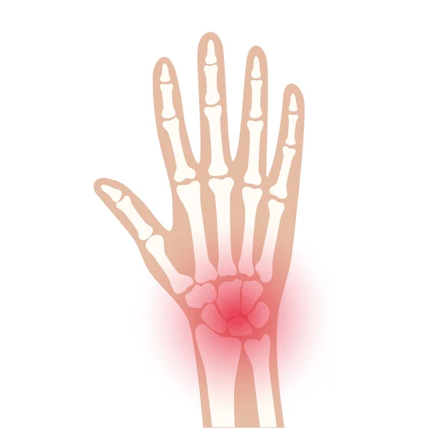 Arthrits x ray — 图库矢量图片