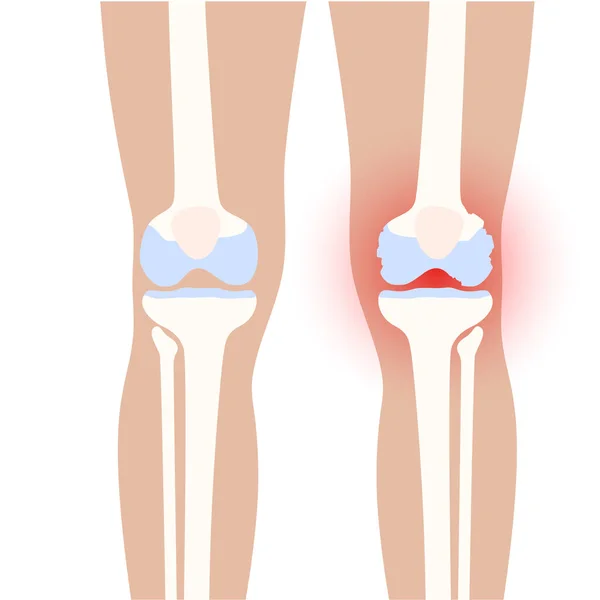 Artritis in het kniegewricht — Stockvector