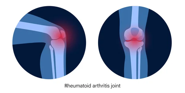 Artritis in het kniegewricht — Stockvector