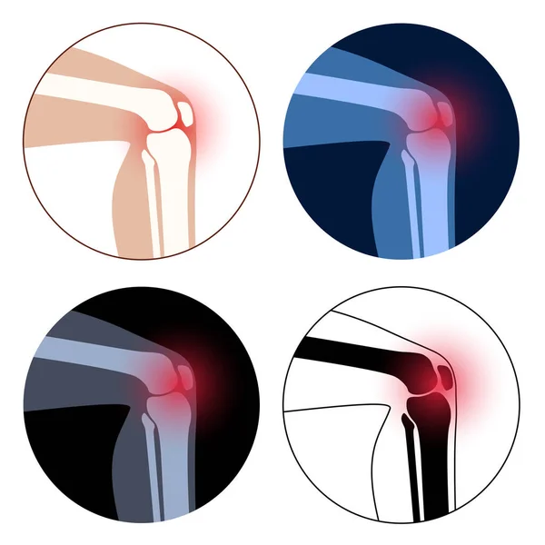 Αρθρίτιδα στην άρθρωση του γόνατος — Διανυσματικό Αρχείο