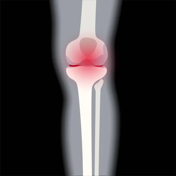 Arthrite dans l'articulation du genou — Image vectorielle