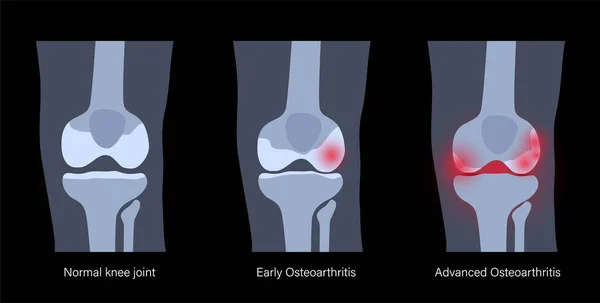 Arthrite dans l'articulation du genou — Image vectorielle