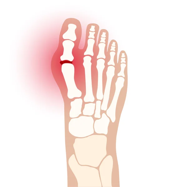관절염의 발 개념 — 스톡 벡터