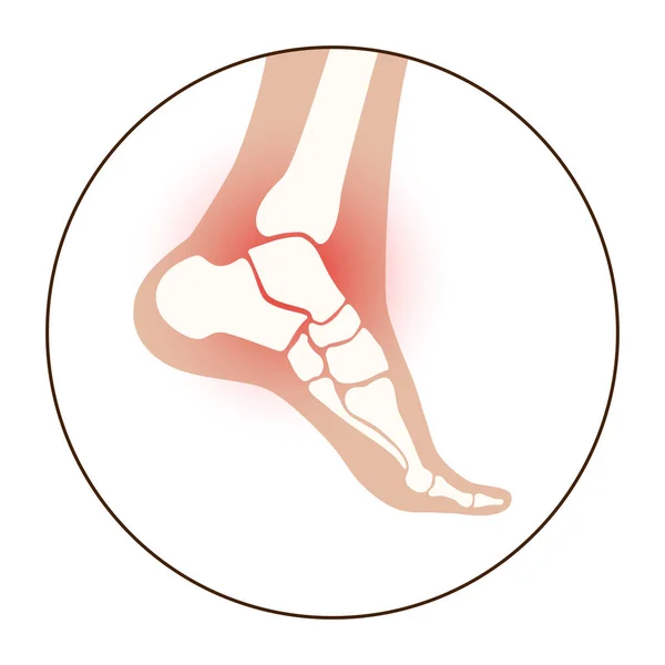 Arthritis-Fußkonzept — Stockvektor