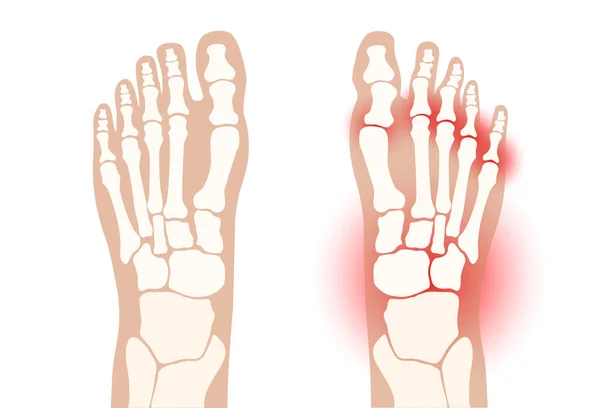 Arthritis konsep kaki - Stok Vektor