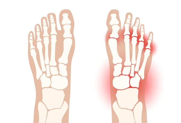Artrite conceito pé —  Vetores de Stock