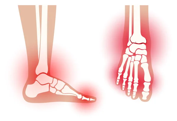 Arthritis foot koncepció — Stock Vector