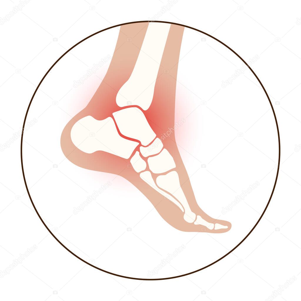 Arthritis joint in the ankle. Osteoarthritis logo for clinic. Leg pain icon. Human foot bone anatomy flat vector illustration. Skeleton x ray scan concept. Painful injury and erosion. Medical poster.