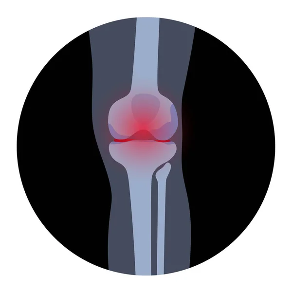 Arthritis in knee joint — Stock Vector