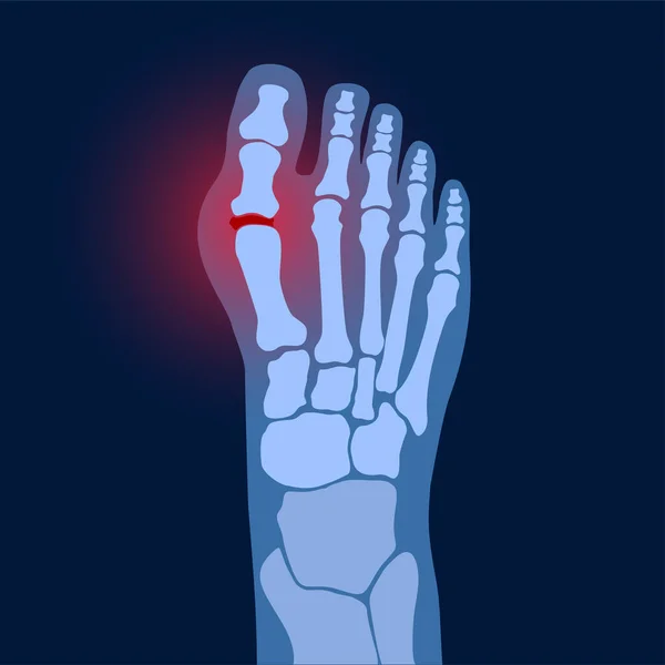 Arthritis-Fußkonzept — Stockvektor