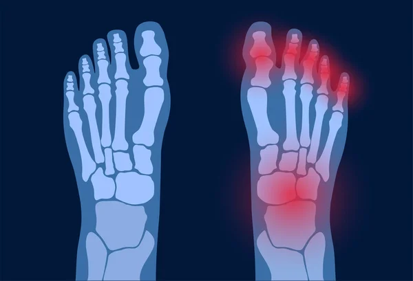 Arthrite pied concept — Image vectorielle