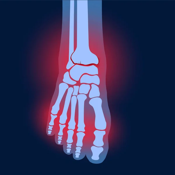 Arthritis-Fußkonzept — Stockvektor