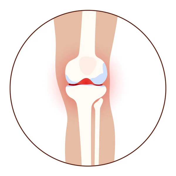 Artritis en la articulación de rodilla — Archivo Imágenes Vectoriales