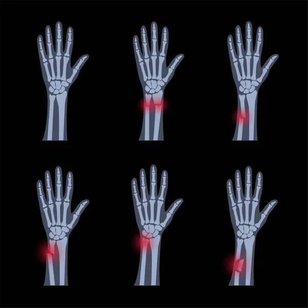 Fracture concept de rayons X — Image vectorielle