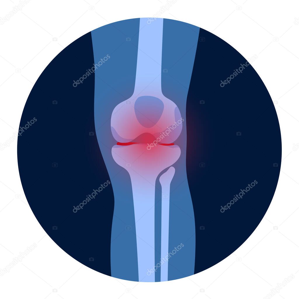 Arthritis knee joint icon. Rheumatoid arthritis clinic logo. Pain in leg. Human bone anatomy flat vector illustration. Skeleton x ray scan concept. Painful injury erosion on medical poster for clinic.