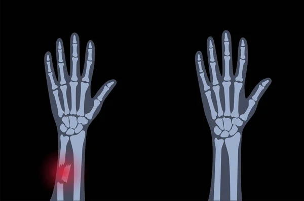 Concepto de fractura por rayos X — Archivo Imágenes Vectoriales
