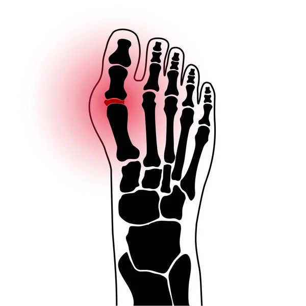 Arthritis-Fußkonzept — Stockvektor