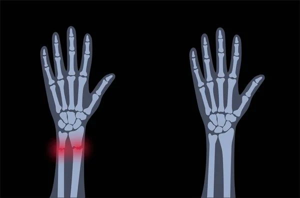 Concepto de fractura por rayos X — Vector de stock