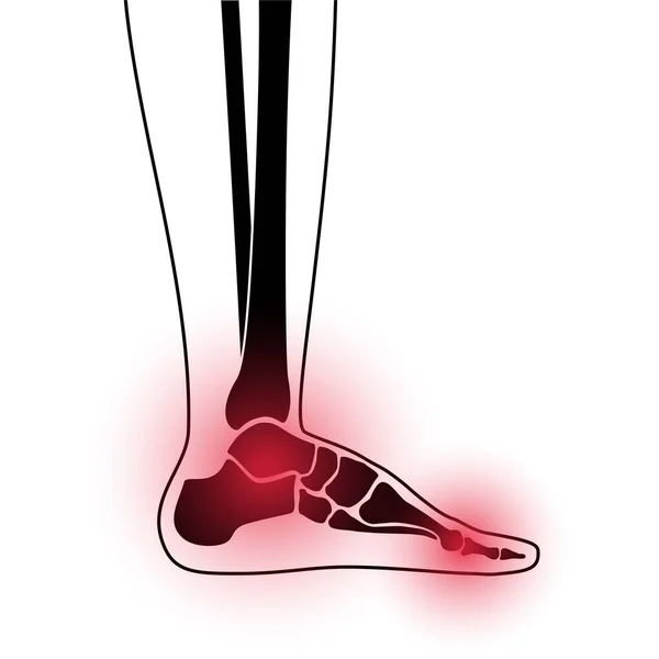 Arthritis foot koncepció — Stock Vector