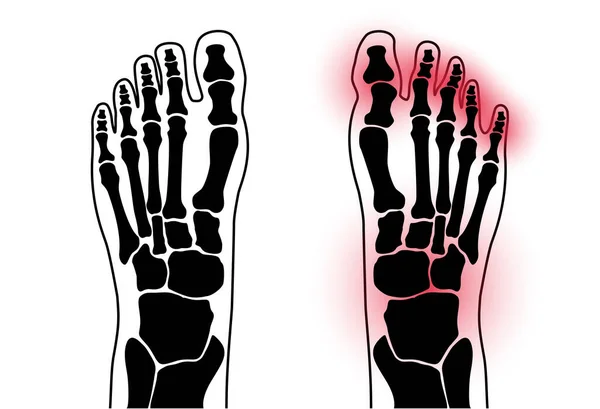 Αρθρίτιδα πόδι έννοια — Διανυσματικό Αρχείο