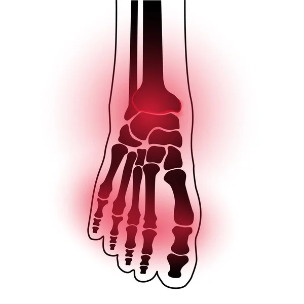 Artritis voet concept — Stockvector