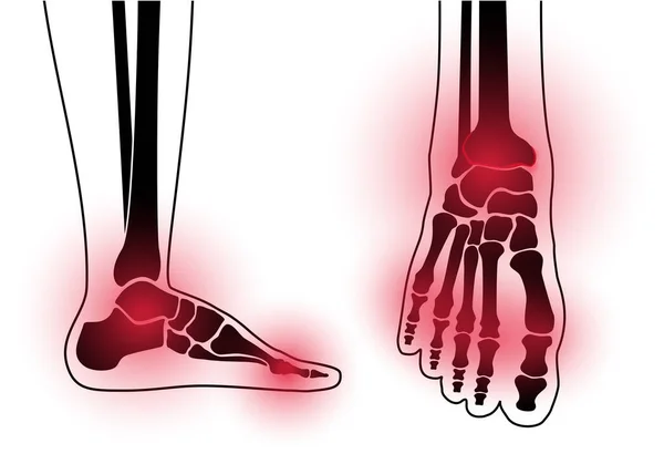 Artritis concepto de pie — Archivo Imágenes Vectoriales