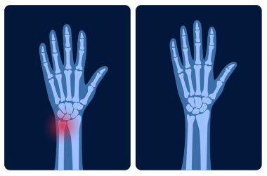 Fraktür x ışını konsepti