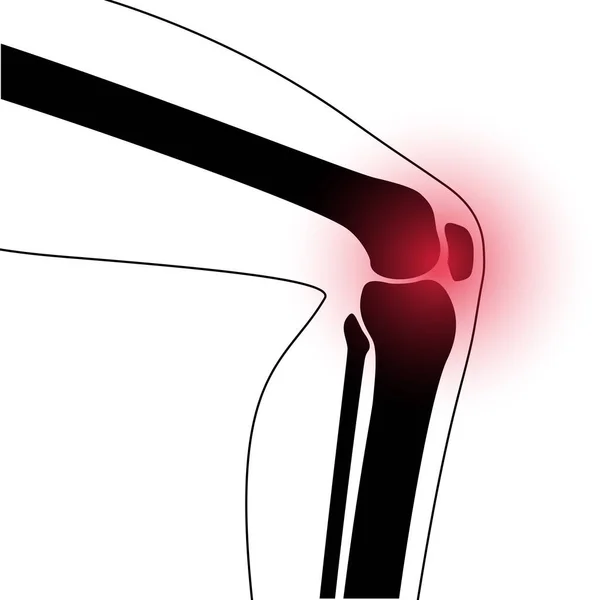 Artrite na articulação do joelho —  Vetores de Stock