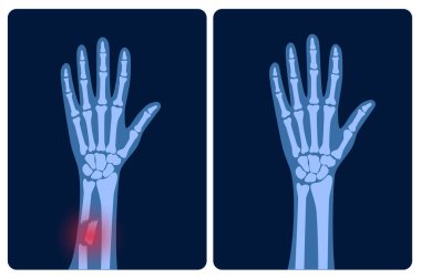 Fraktür x ışını konsepti