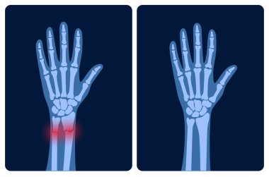 Fraktür x ışını konsepti