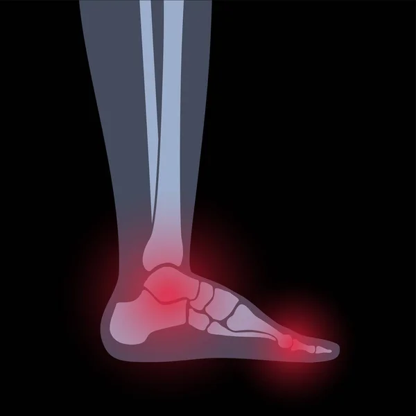 Arthritis konsep kaki - Stok Vektor
