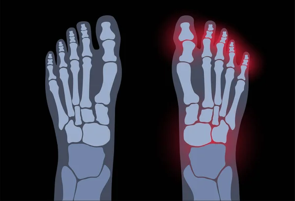 Arthritis foot concept — Stock Vector
