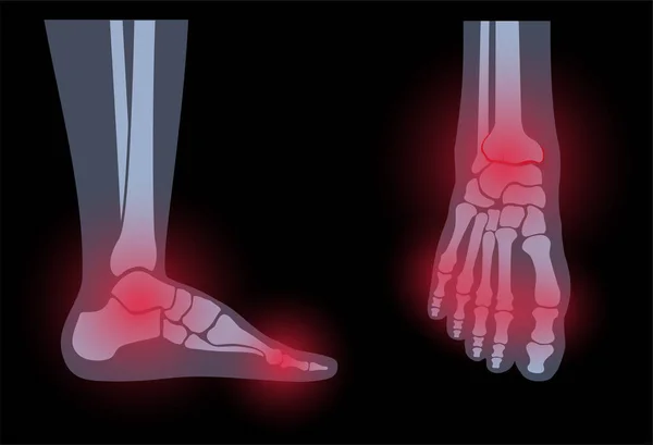 Arthrite pied concept — Image vectorielle