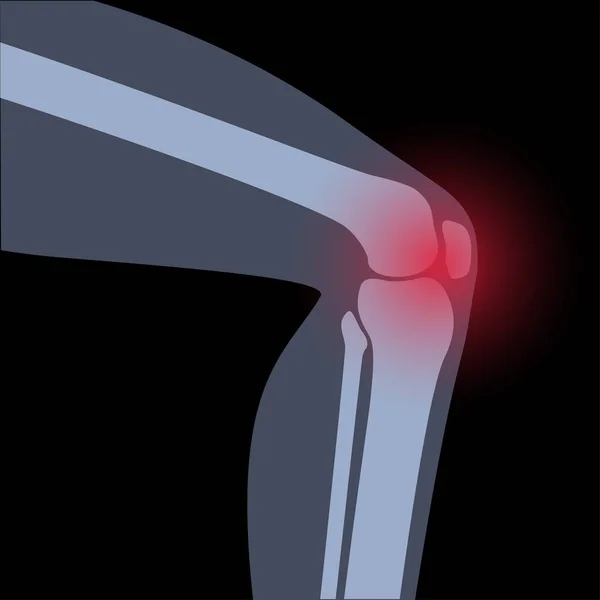 Arthrite dans l'articulation du genou — Image vectorielle