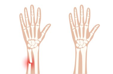 Fraktür x ışını konsepti