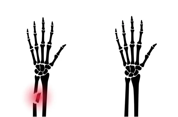 Fratura conceito de raio x —  Vetores de Stock