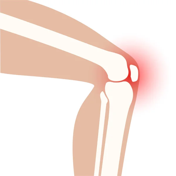 膝关节关节炎 — 图库矢量图片