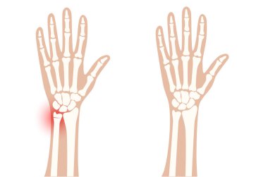 Fraktür x ışını konsepti