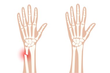 Fraktür x ışını konsepti