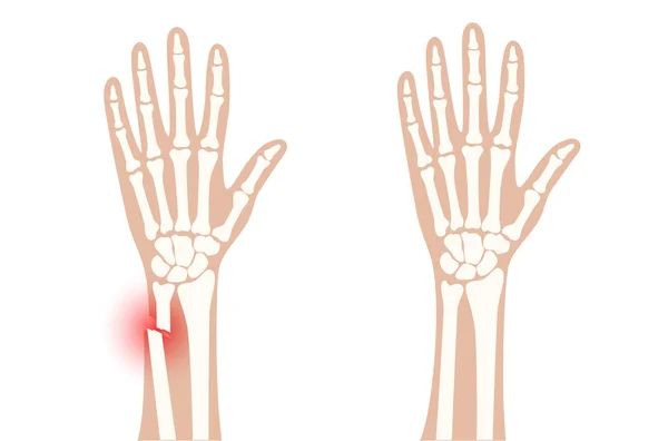 Concepto de fractura por rayos X — Vector de stock