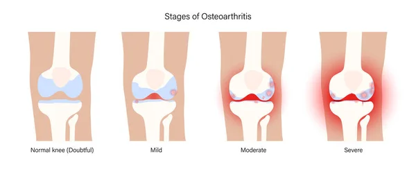 Artrite dell'articolazione del ginocchio — Vettoriale Stock