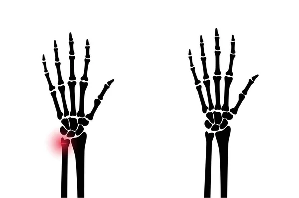 Fratura conceito de raio x — Vetor de Stock