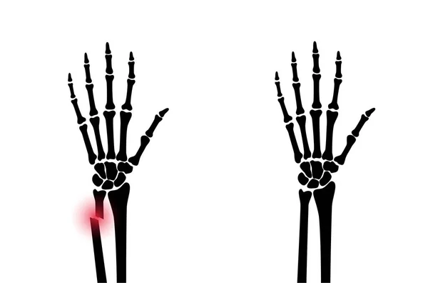 Concepto de fractura por rayos X — Vector de stock