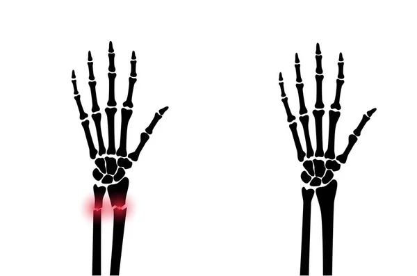 骨折x線の概念 — ストックベクタ