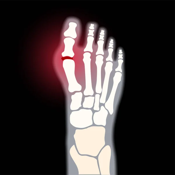 Arthritis-Fußkonzept — Stockvektor