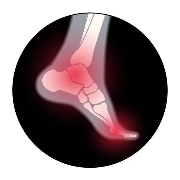 Αρθρίτιδα πόδι έννοια — Διανυσματικό Αρχείο