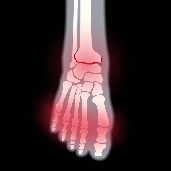 Artrite conceito pé —  Vetores de Stock