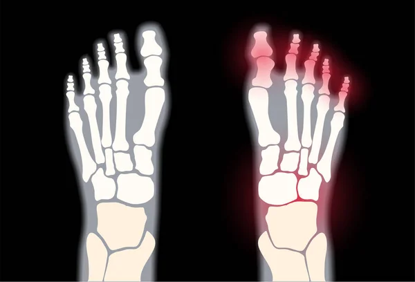 Arthritis foot concept — Stock Vector