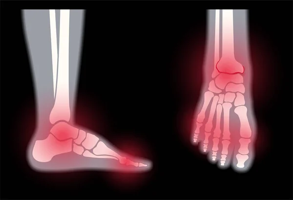 Arthritis konsep kaki - Stok Vektor